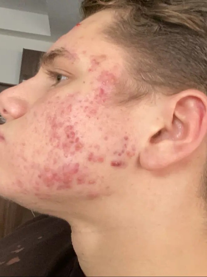 Before — 10 weeks of use with the Dermé G11 laser mask