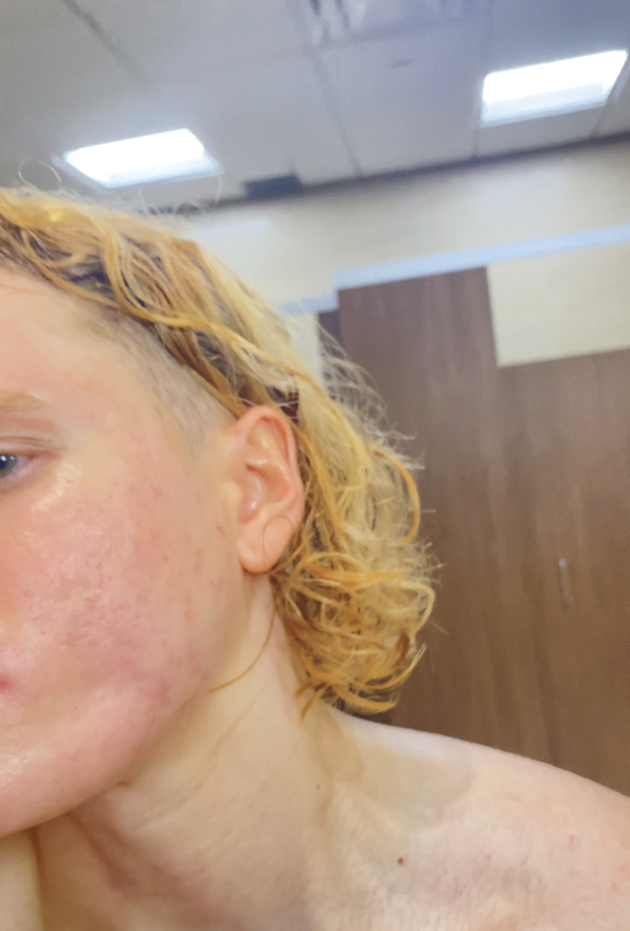 After — 10 weeks of use with the Dermé G11 laser mask